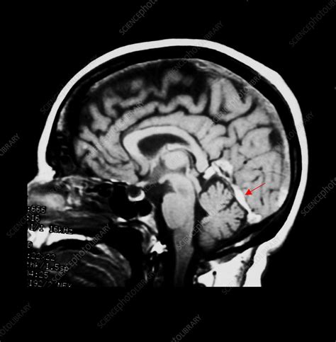 MRI of Dural Sinus Thrombosis - Stock Image - M175/0603 - Science Photo ...