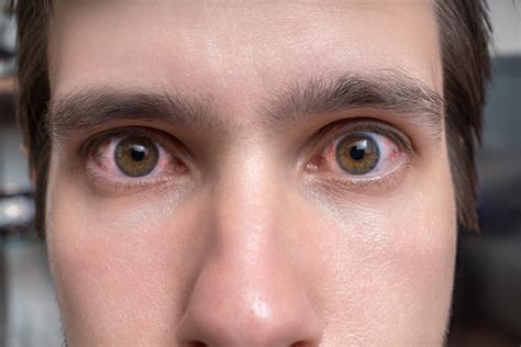 Why Smoking Cannabis Causes Red, Bloodshot Eyes – MJ PurePlay Index