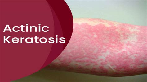 Actinic Keratosis: Causes, Symptoms, Risk Factors, Treatments And ...