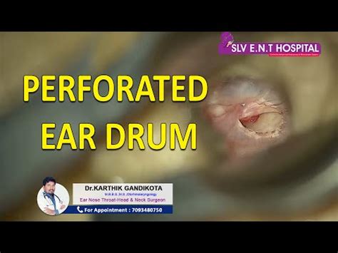 PERFORATED EAR DRUM - YouTube