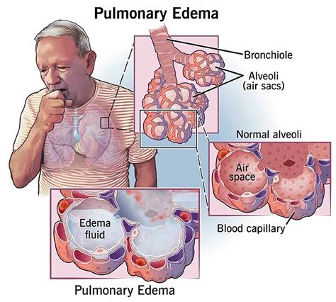 Swimming induced pulmonary edema, causes, prevention, symptoms ...