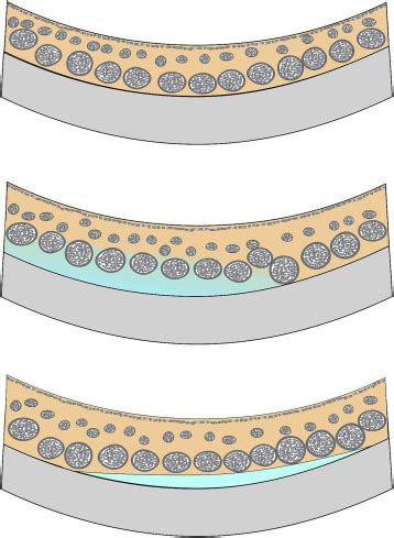 Loculation of Fluid in the Posterior Choroid in Eyes With Central Serous Chorioretinopathy ...