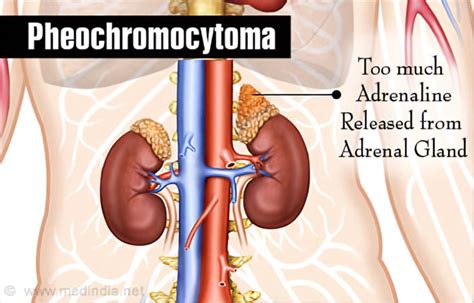 Pheochromocytoma | Adrenal Gland Tumor: Causes, Symptoms, Diagnosis, Treatment, Prevention