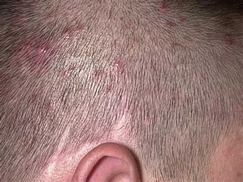 Share more than 72 pimple on head under hair latest - in.eteachers