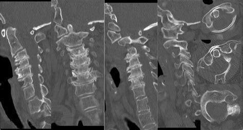 C1 C2 Subluxation Treatment - Pregnant Center Informations