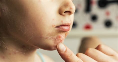 A dermatologist explains exactly how to talk to your kids about child acne.