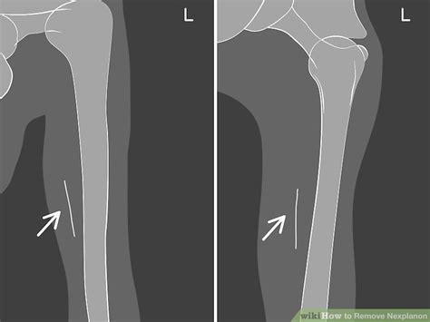 How to Remove Nexplanon: Where to Get It Removed & More