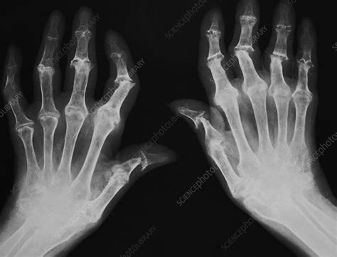 Arthritic hands, X-ray - Stock Image - M110/0679 - Science Photo Library