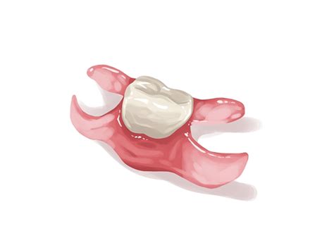 Best Metal Partial Dentures in Rogers, AR | Exo Dental