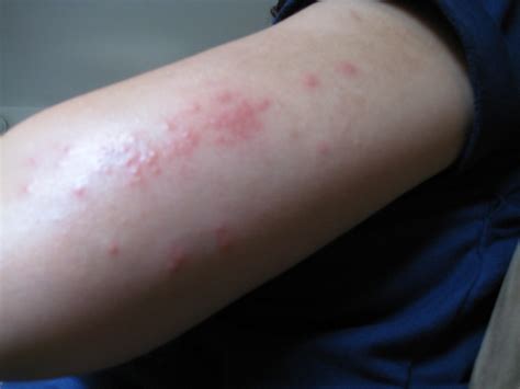 What are Over – the – Counter Treatments for Scabies?