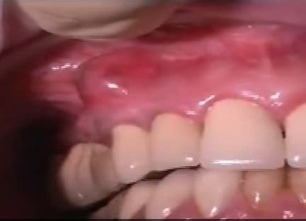 What is a Tooth Abscess? (Updated) | Tooth Pain and Infections