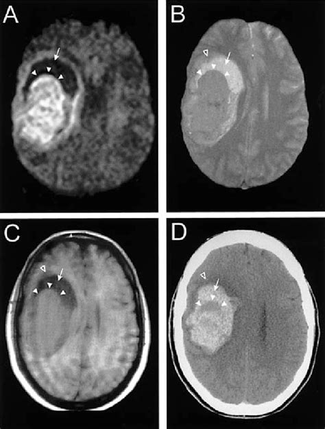 Figure 1 from CT and MRI in Acute Hemorrhagic Stroke | Semantic Scholar