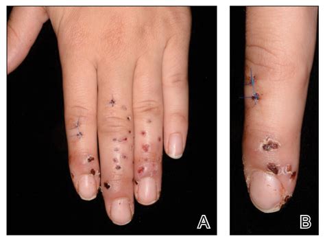 Granulomatous Reaction After Cholla Cactus Spine Injury | MDedge ...