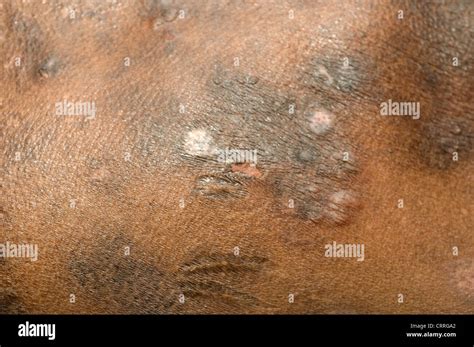 A man with a fungal skin disease Stock Photo - Alamy