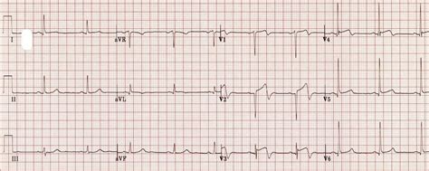 Wellens Syndrome • LITFL • ECG Library Eponym