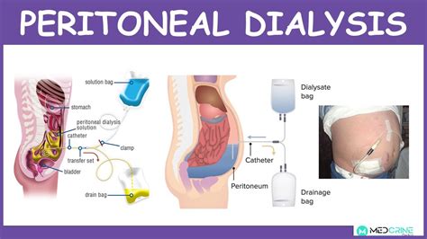 Peritoneal Dialysis Diagram