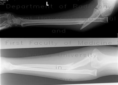 Radiology case: Monteggia fracture