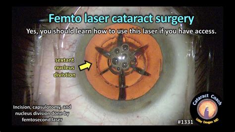 CataractCoach 1331: femtosecond laser cataract surgery - YouTube