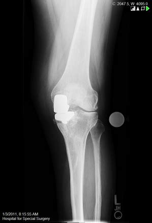 Unicondylar Knee Replacement - Partial Knee Replacement