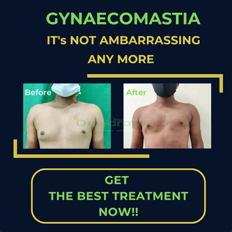 Gynecomastia Surgery - Shared By Odisha's Top Plastic Surgeon