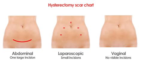 Pictures of Hysterectomy Scars and Incisions from Different Surgical Procedures - Partial ...