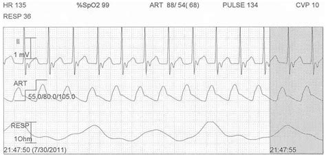 Pedi cardiology: EKG: Junctional rhythm with retrograde P wave