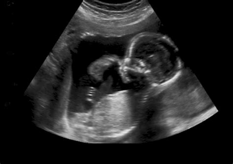 Third trimester ultrasound:the growth scan - Dr Colin Walsh