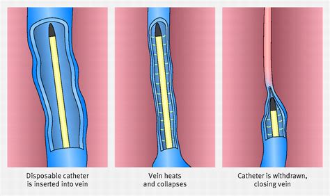 The management of superficial venous incompetence | The BMJ