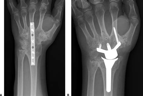 Clinical Outcomes of Total Wrist Arthroplasty - Journal of Hand Surgery