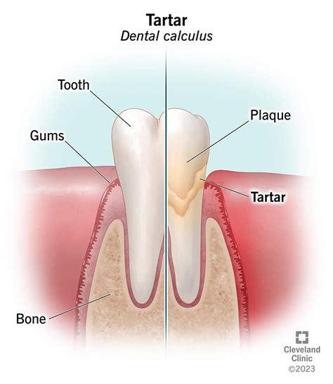 Tartar on Teeth (Dental Calculus): Causes & Removal