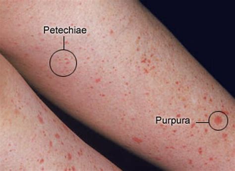 Petechiae Pictures, Causes, Symptoms, Diagnosis and Treatment ...