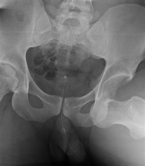 ANTERIOR DISLOCATION OF THE HIP | Buyxraysonline