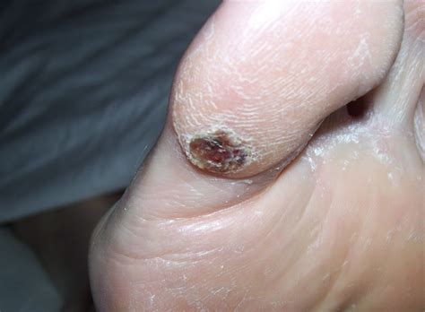 foot drop..blood blister..my left toe and it is so painful c i live
