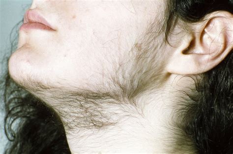 Hirsutism - Causes, Signs, Symptoms, Hirsutism Treatment