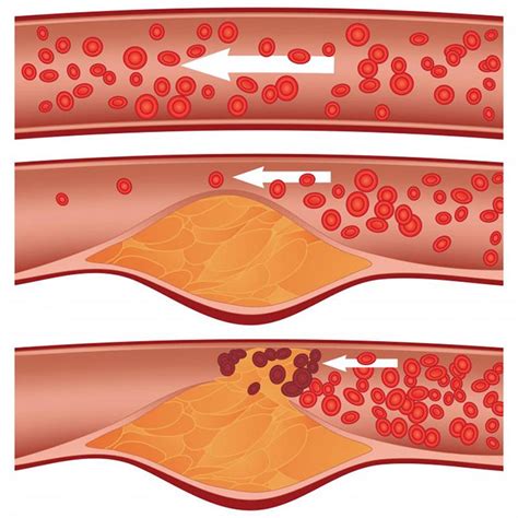 Remove Calcium Deposits & Plaque From Your Arteries In 2024