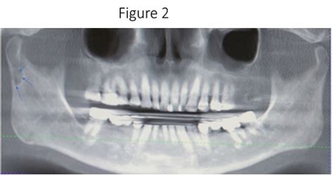 A Rare Variant of the Stafne Bone Cavity Localized to the Subcondylar Region of the Mandible: A ...