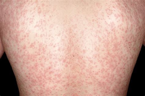 Pityriasis rosea - NHS