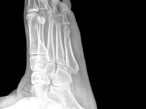 Dancer’s Fracture: Causes, Symptoms, Diagnosis & Treatment