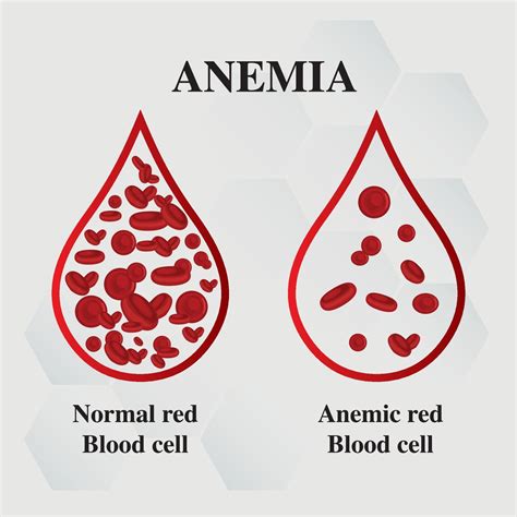 Anemia amount of red blood Iron deficiency anemia difference of Anemia amount of red blood cell ...