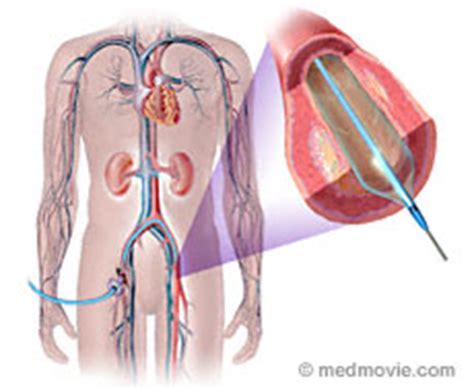 Peripheral Angioplasty