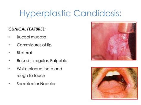 Candidal infections of the oral cavity