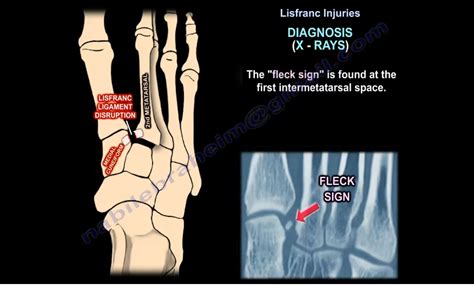 Lisfranc Joint Injuries — OrthopaedicPrinciples.com