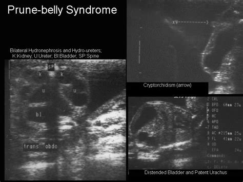 Nagendra's Radiology Blog: RADIOLOGY MCQ---Prune- belly syndrome