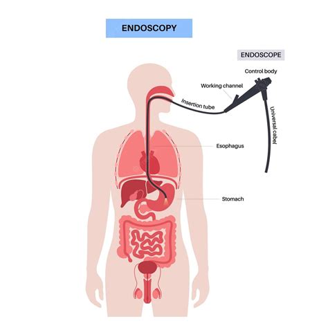 Premium Vector | Gastroscopy procedure Gastroenterologist uses a gastroscope Stomach and ...