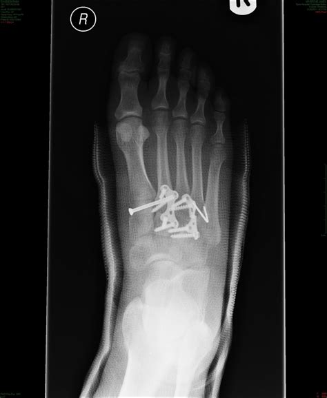 Yes I've got a Lisfranc injury too !: X rays & images of the foot