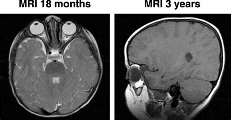 Orbital Reconstruction for Pulsatile Exophthalmos Secondary... : Annals of Plastic Surgery