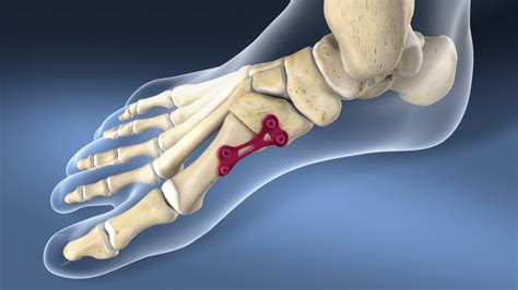 ARTHRODESIS - Longhorn Brain and Spine