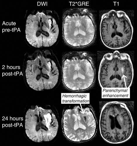 MRI Detection of Early Blood-Brain Barrier Disruption | Stroke