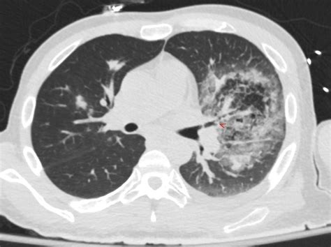 219Lu Acute Aspergillus Fungal Infection Halo Sign and Reversed Halo Sign | Lungs