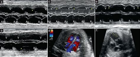 Ventricular Bigeminy Symptoms